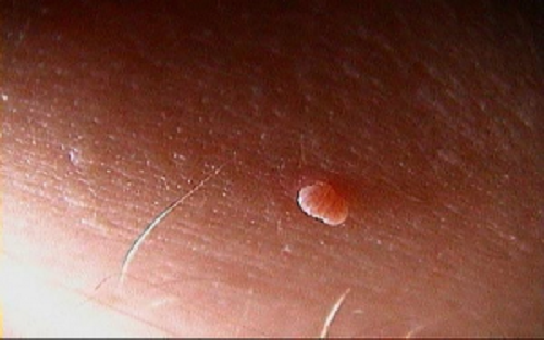 Mụn thịt màu đỏ
