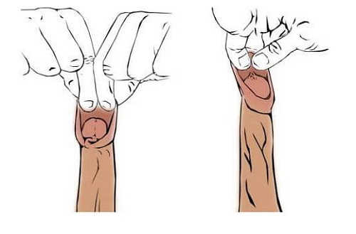 Nên hay không chữa xuất tinh sớm bằng cách cắt bao quy đầu?