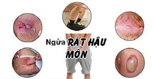 Ngứa hậu môn