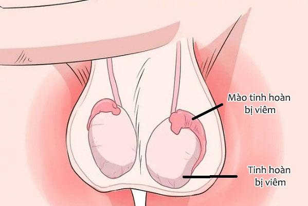 Tìm hiểu về bệnh viêm tinh hoàn
