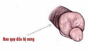 Nguyên nhân da bao quy đầu bị sưng phồng sau quan hệ