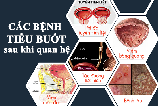 Tiểu buốt sau khi quan hệ là biểu hiện của bệnh gì