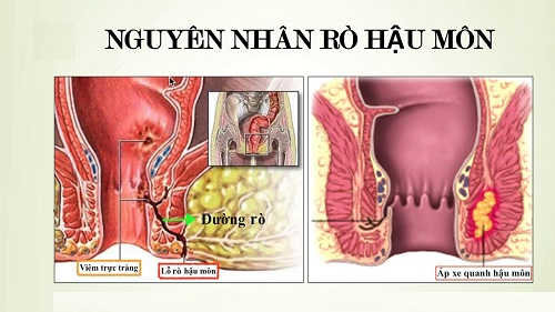 Nguyên nhân rò hậu môn