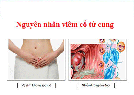 Phân biệt các loại viêm cổ tử cung hay gặp ở nữ giới