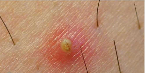 Nổi mụn ở tinh hoàn