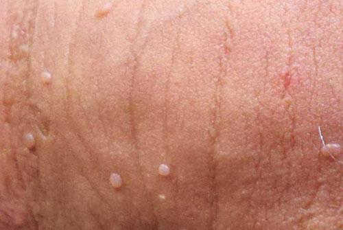 Nổi mụn trắng ở bao quy đầu có nguy hiểm không?