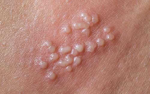 Cách trị nổi mụn trắng ở bao quy đầu như thế nào?