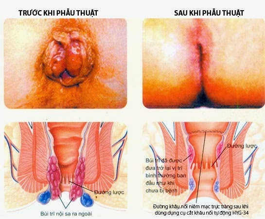 Bị chảy máu sau phẫu thuật cắt búi trĩ có nguy hiểm không