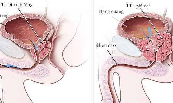 Phì đại tuyến tiền liệt ở nam giới