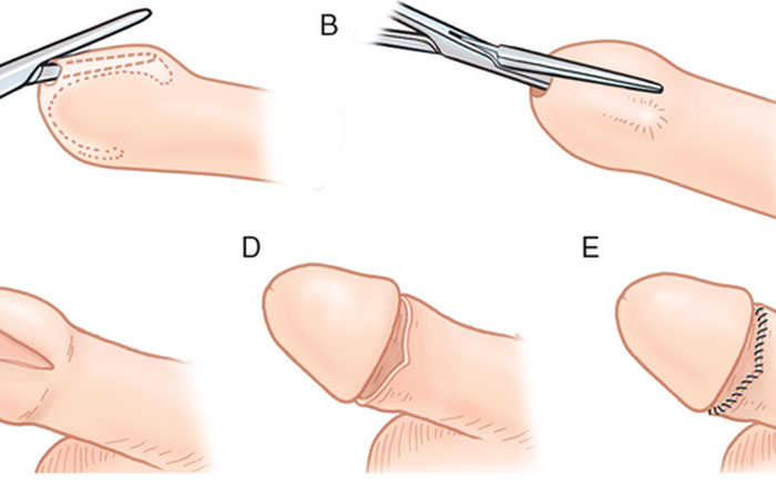 phương pháp cắt bao quy đầu