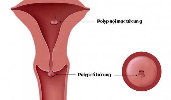 Polyp cổ tử cung