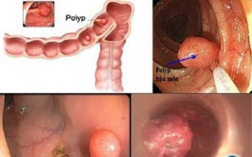 Polyp hậu môn