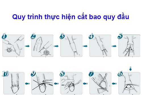 Quá trình cắt bao quy đầu 