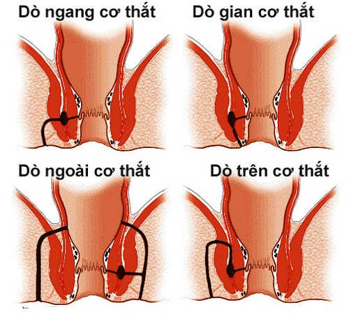 Rò hậu môn bệnh học