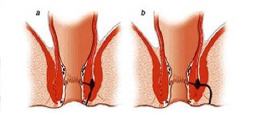 Rò hậu môn tiền đình