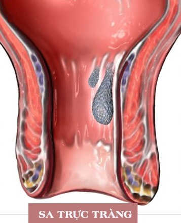 Sa trực tràng