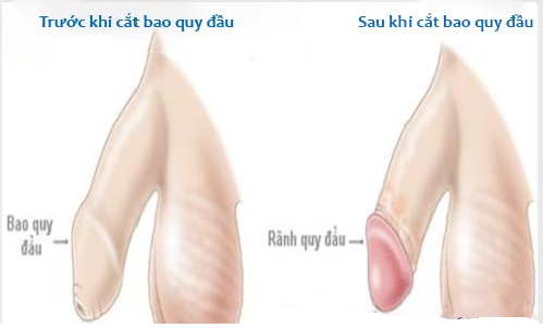 Những lợi ích sau khi thực hiện cắt bao quy đầu