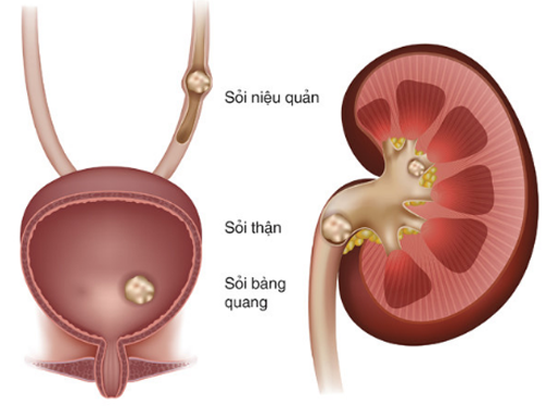 Sỏi đường tiết niệu