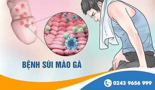 Sùi mào gà có chữa dứt điểm được không