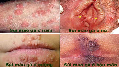 Sùi mào gà thường mọc ở đâu, có chữa được không