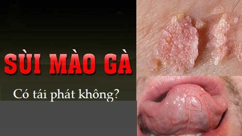 Sùi mào gà có tái phát không?