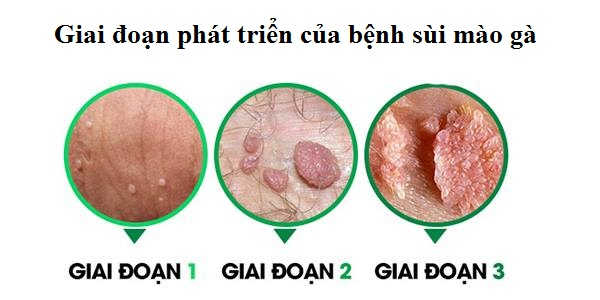 Sùi mào gà giai đoạn phát triển