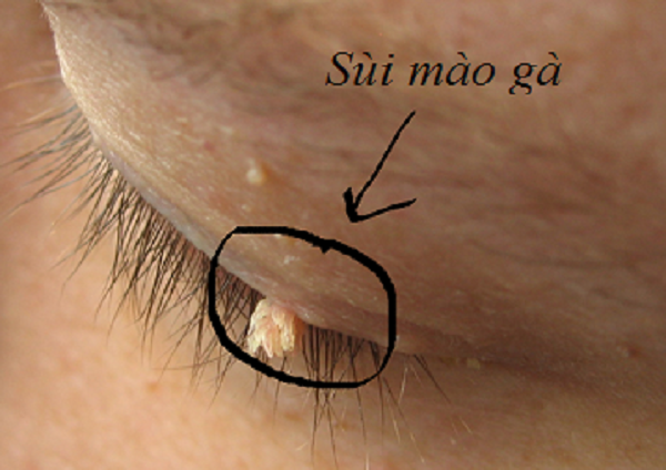 Sùi mào gà ở mắt