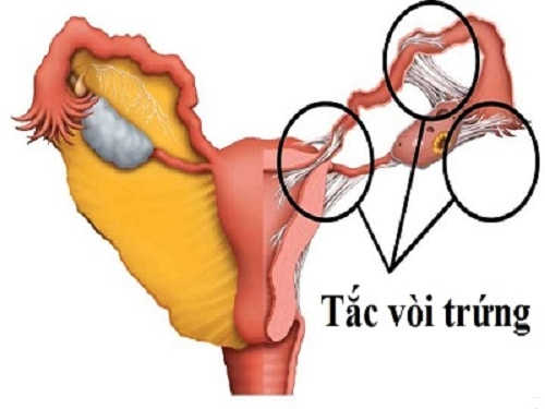 Tắc vòi trứng
