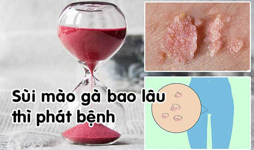 Sùi mào gà ủ bệnh có lâu không