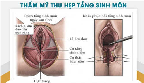 Phẫu thuật thu hẹp tầng sinh môn