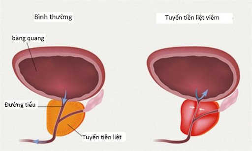 Tinh trùng đặc do viêm tuyến tiền liệt 