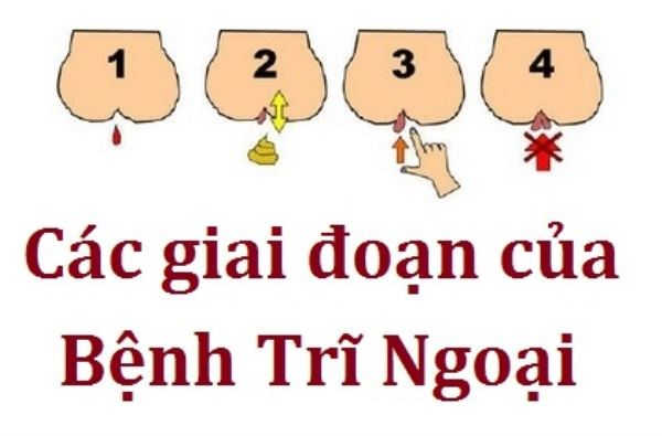 Trĩ ngoại giai đoạn đầu