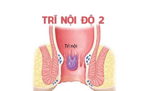 Trĩ nội độ 2