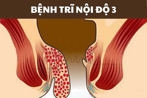 Bệnh trĩ nội độ 3