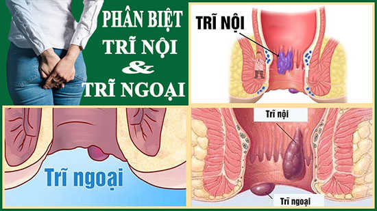 Phân biệt trĩ nội, trĩ ngoại và cách chữa trị hiệu quả nhất hiện nay