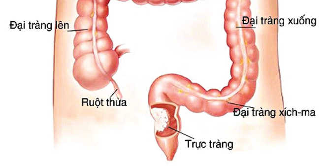 Bệnh trĩ sau sinh gây ra ung thư trực tràng