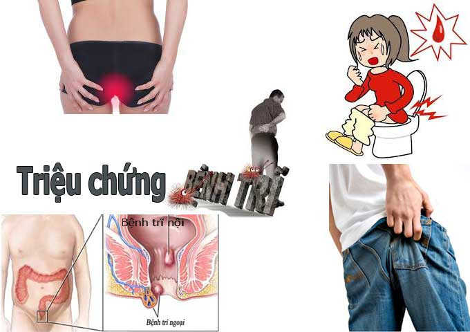 Dấu hiệu, nguyên nhân và cách điều trị bệnh trĩ sẽ giúp mọi người biết cách nhận biết bệnh trĩ