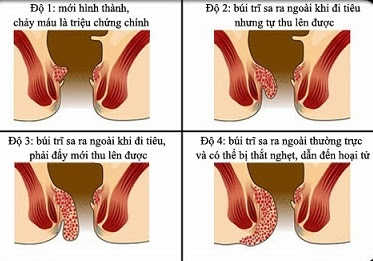 Bệnh trĩ nội độ 2 có nguy hiểm không, không chữa trị có sao không