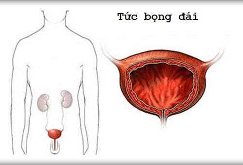 Triệu chứng căng tức bàng quang có cần khám bác sĩ