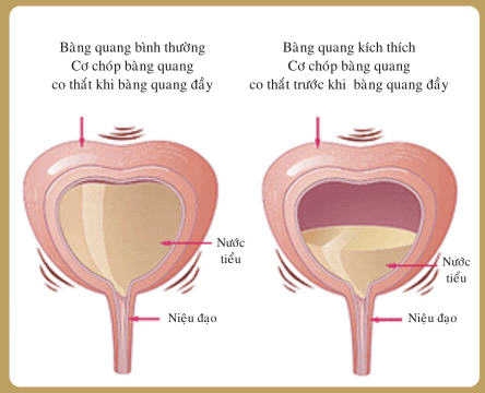 Triệu chứng căng tức bàng quang là bệnh gì?