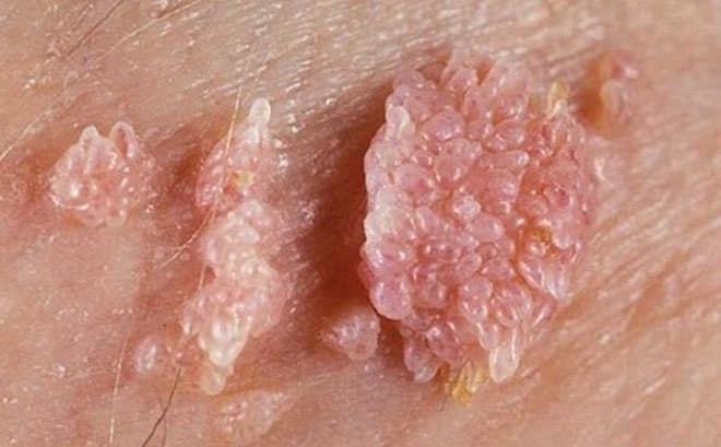 Triệu chứng sùi mào gà ở nam