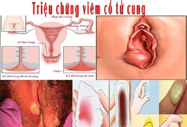 Phân biệt các loại viêm cổ tử cung hay gặp ở nữ giới