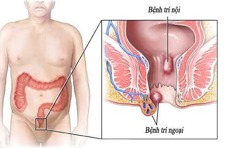Bệnh trĩ nên ăn gì và kiêng gì để nhanh khỏi bệnh nhất