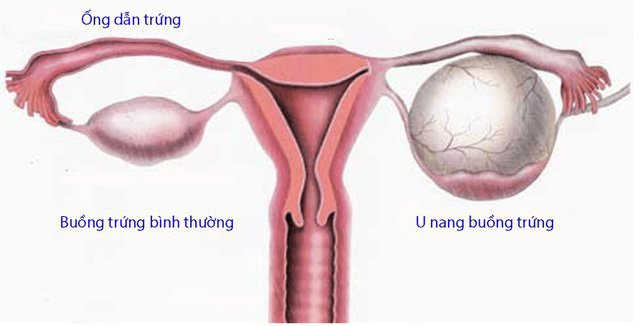 U lành tính buồng trứng