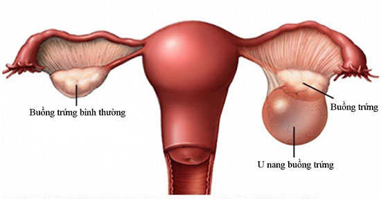 Sau khi mổ u nang buồng trứng nên ăn gì