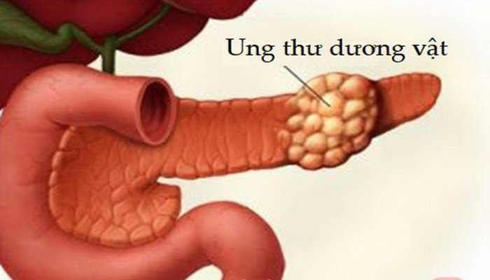 Ung thư dương vật