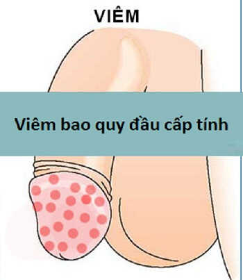 Viêm bao quy đầu cấp tính