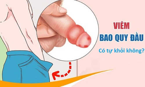 Bệnh viêm bao quy đầu có tự khỏi được không?