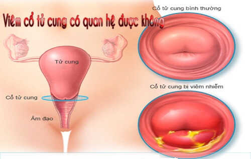 Viêm cổ tử cung có quan hệ được không