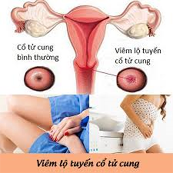 Viêm lộ tuyến tử cung gây ra khí hư trắng sữa 